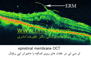 epiretinal membrane OCT  او سی تی در غشاء های روی شبکیه یا مامبران اپی رتینال 